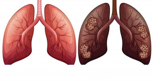 Akciğer kanserine yüzde 90 tütün kullanımı neden oluyor